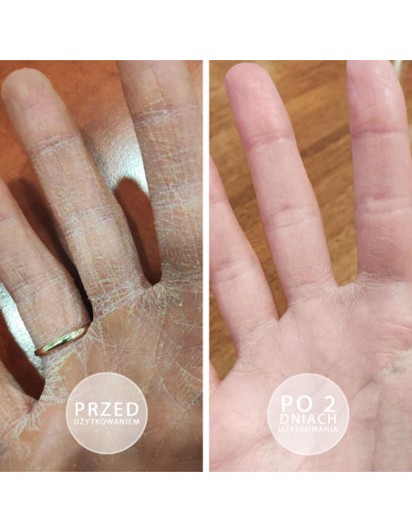 S.O.S. - Intensywnie natłuszczająca maść z witaminą E 5 x 15ml