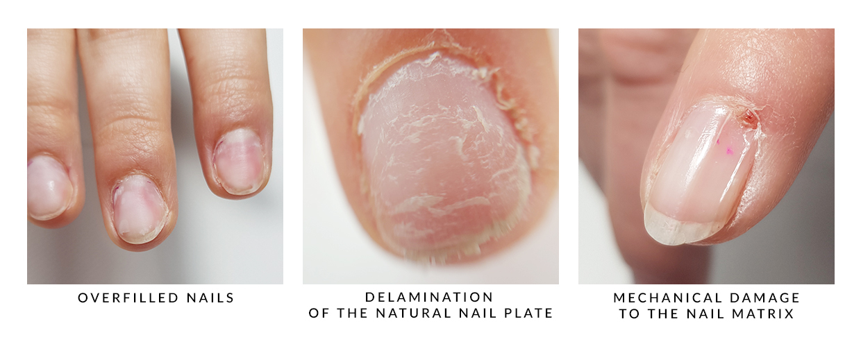Damage to the natural nail plate - what they are and how to deal with them?  - SPN Nails